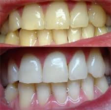 Teeth Whitening