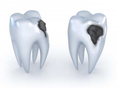 How does a tooth decay occur?