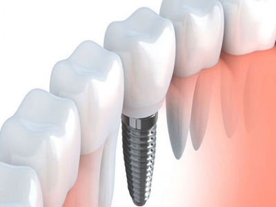 What is Implantation? How  is it done?