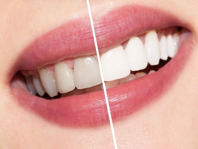 What is Teeth Whitening, How is it done